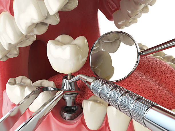 Best Emergency Dentist for Knocked-Out Tooth in Amsterdam, NY